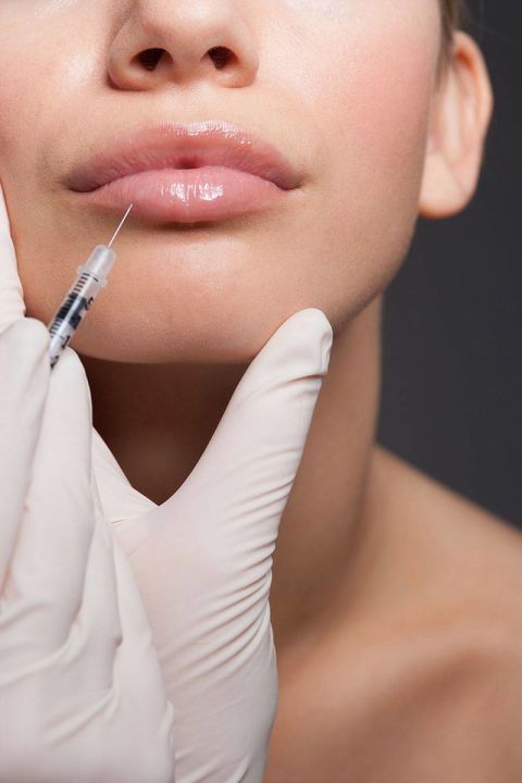 Dermal Lip Fillers